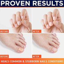 Load image into Gallery viewer, Revolutionary Toe And Fingernail Nail Fungus Home Remedies Treatment Laser Device