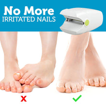 Load image into Gallery viewer, Revolutionary Toe And Fingernail Nail Fungus Home Remedies Treatment Laser Device

